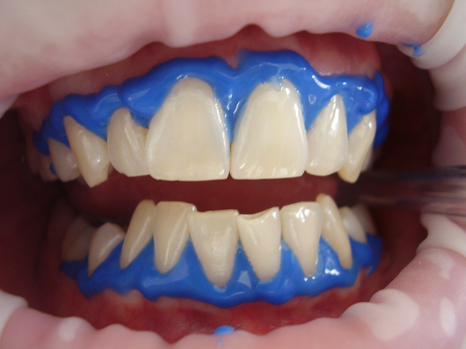Sbiancamento dei denti